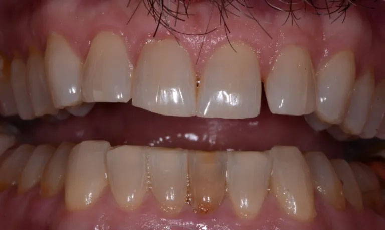 Michael J. Perona, DDS | Oral Cancer Screening, Teeth Whitening and Crowns