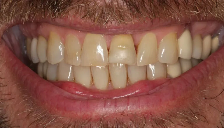 Michael J. Perona, DDS | Air Abrasion, Implant Restorations and TMJ Disorders