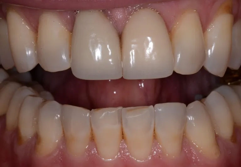 Michael J. Perona, DDS | Crowns, Dental Bridges and Night Guards