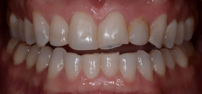 Michael J. Perona, DDS | Dental Cleanings, Air Abrasion and Invisalign reg 