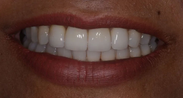 Michael J. Perona, DDS | Dental Fillings, Full Mouth Reconstruction and Ceramic Crowns