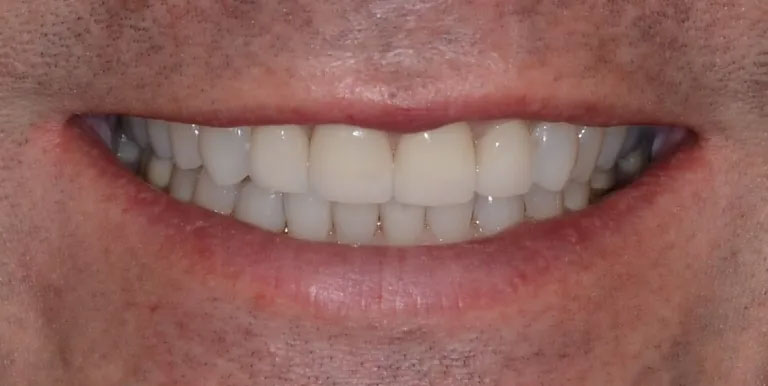 Michael J. Perona, DDS | Fluoride Treatment, Invisalign reg  and All-on-4 reg 