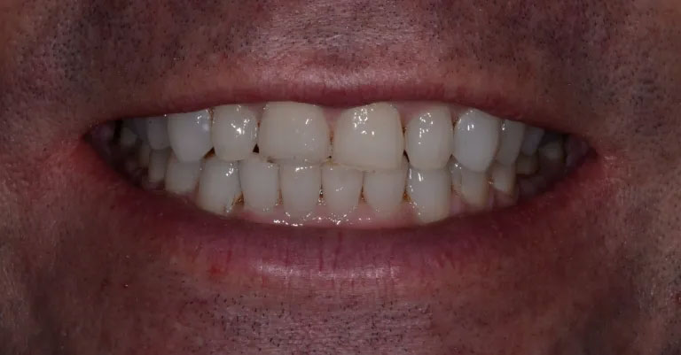 Michael J. Perona, DDS | Snoring Appliances, Invisalign reg  and Veneers