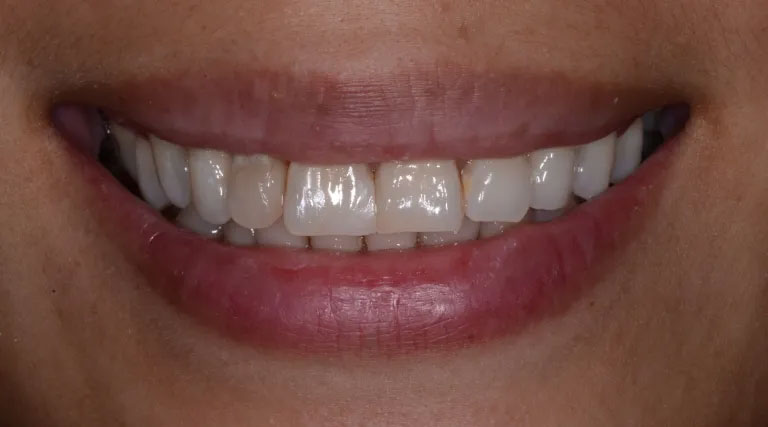 Michael J. Perona, DDS | Sleep Apnea, Teeth Whitening and Veneers