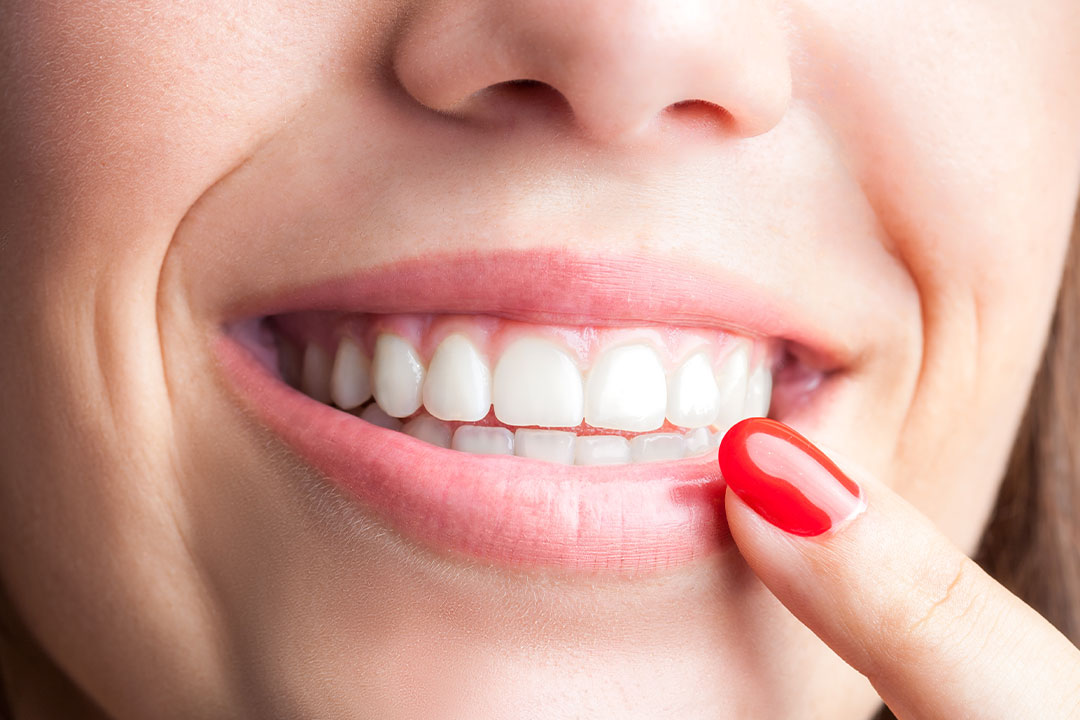 Michael J. Perona, DDS | Snoring Appliances, Inlays amp Onlays and Crowns