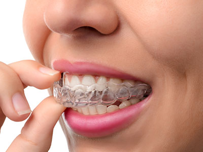 Michael J. Perona, DDS | Night Guards, Intraoral Camera and CEREC