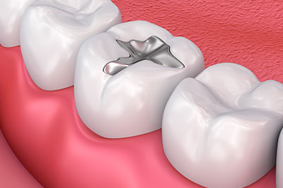 Michael J. Perona, DDS | Sports Mouthguards, Night Guards and Full Mouth Reconstruction