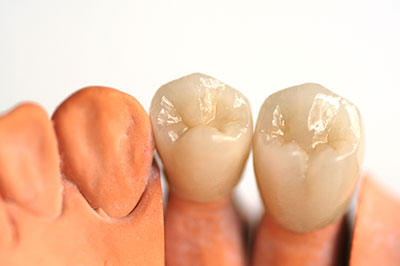 Michael J. Perona, DDS | Full Mouth Reconstruction, Air Abrasion and Veneers