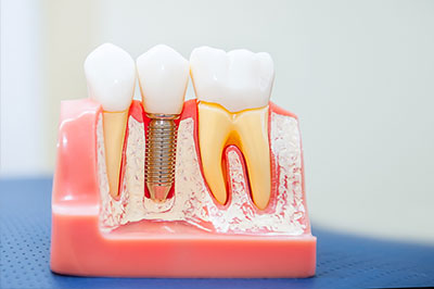 Michael J. Perona, DDS | Full Mouth Reconstruction, Teeth Whitening and Veneers