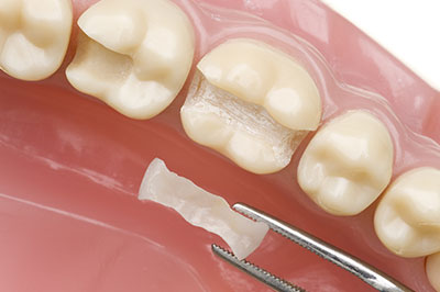 Michael J. Perona, DDS | Invisalign reg , CEREC and Fluoride Treatment