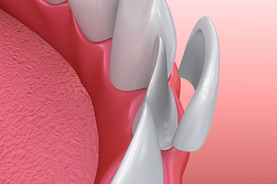 Michael J. Perona, DDS | Oral Exams, All-on-4 reg  and Dental Bridges