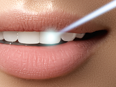 Michael J. Perona, DDS | Intraoral Camera, Invisalign reg  and Sleep Apnea